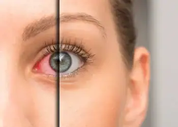 خشکی چشم با لنز؛ علت و راهکار